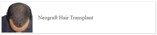 Neograft Hair Transplant
